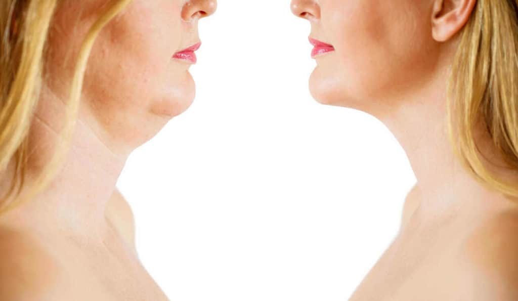 Double Chin treatment Richmond upon Thames before and after results