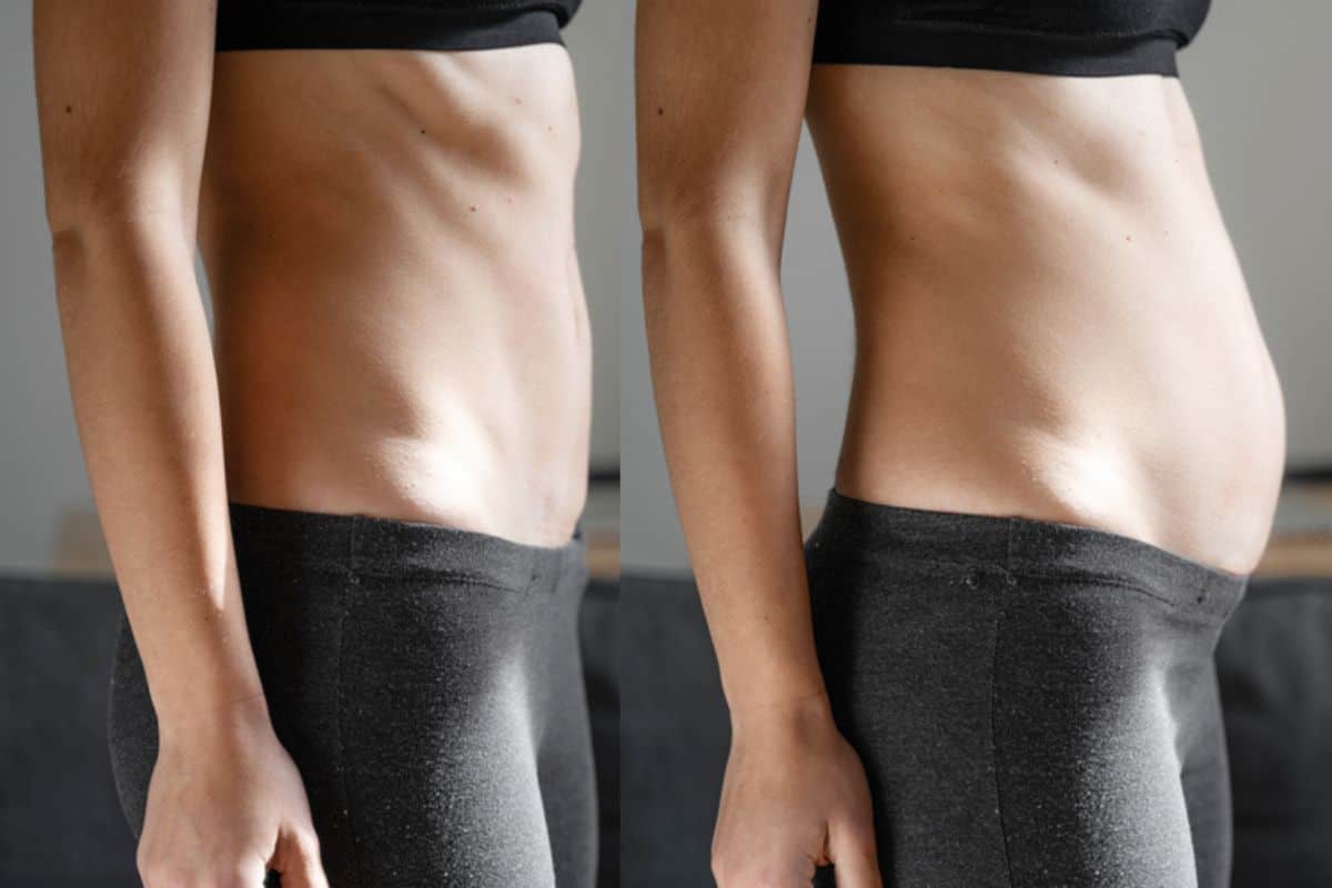 How long does diastasis recti take to improve Richmond upon Thames?