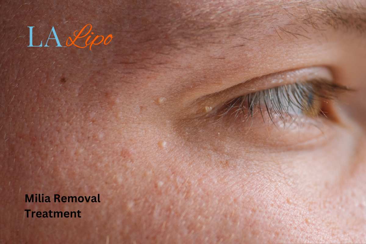 Cryopen Milia Removal: Is It the Easiest and Safest Option Richmond upon Thames?