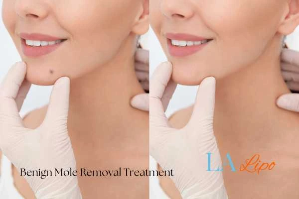 woman's before and after mole removal Richmond upon Thames results