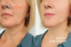 hi-fu for wrinkles Richmond upon Thames before and after results