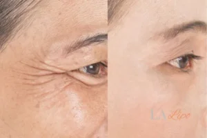 Before and after results of woman - HI-fu wrinkles reduction treatment Richmond upon Thames