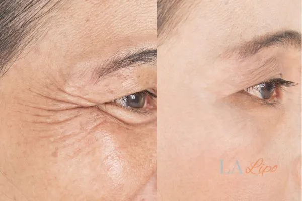 Before and after results of woman - HI-fu wrinkles reduction treatment Richmond upon Thames