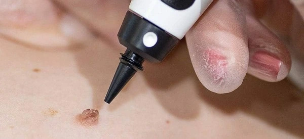 skin tag removal using cryopen Richmond upon Thames
