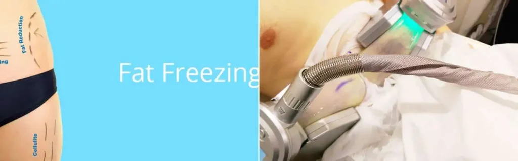 Fat freezing Richmond upon Thames on multiple areas of the body