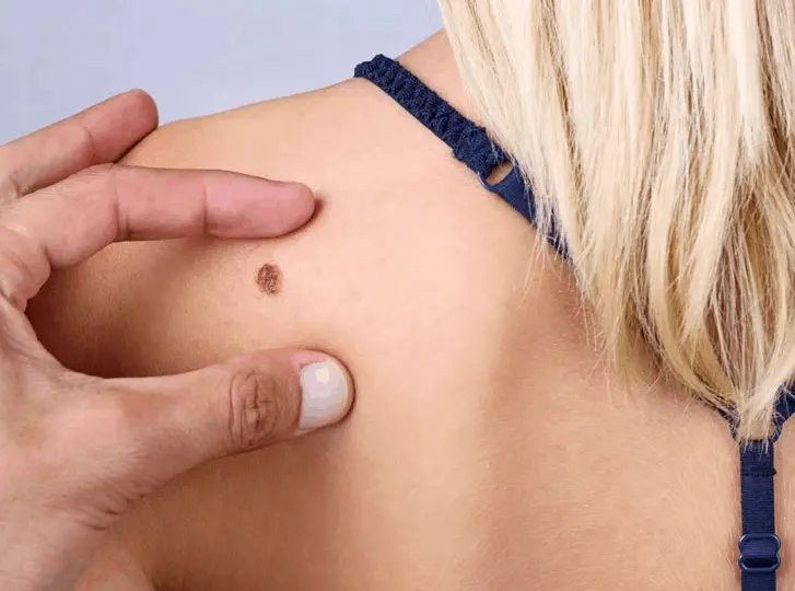 woman having mole removal Richmond upon Thames consultation before treatment.