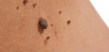 image of a skin tag Richmond upon Thames