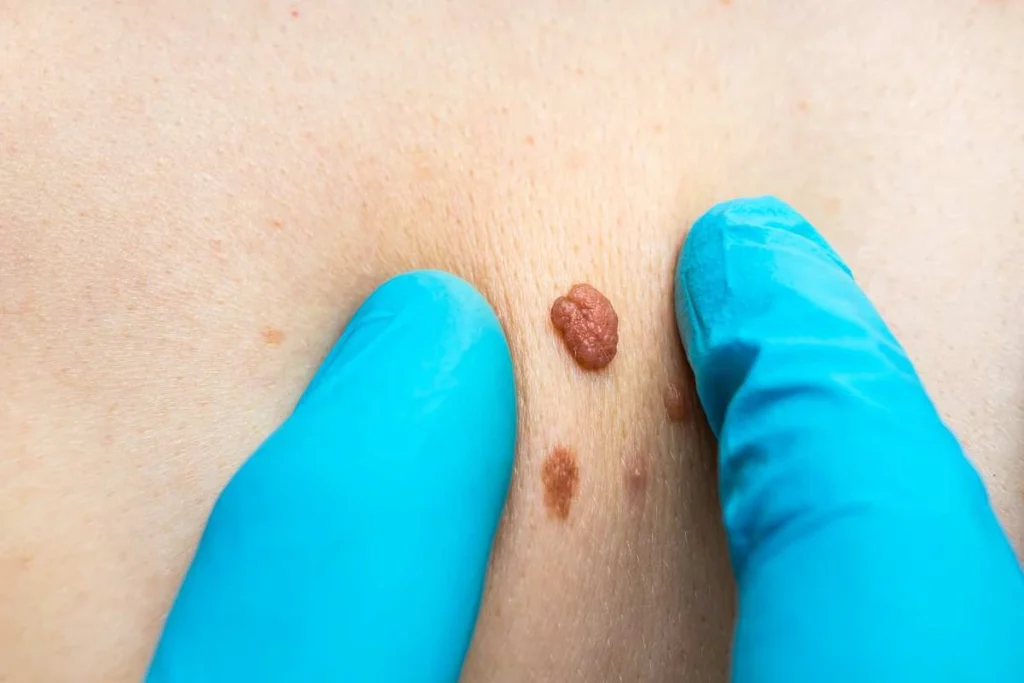 Consultant examining a skin tag Richmond upon Thames