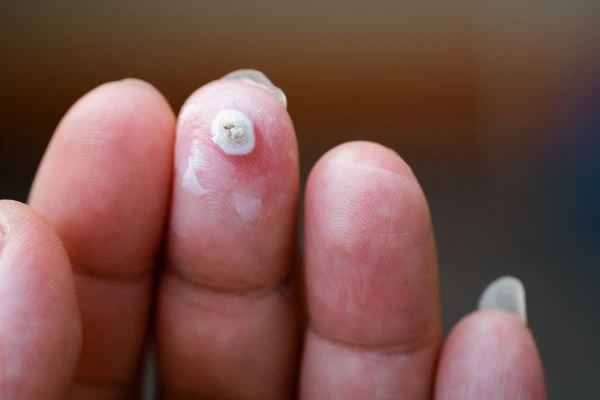 wart on person finger - cryotherapy to treat from LA LIPO Richmond upon Thames