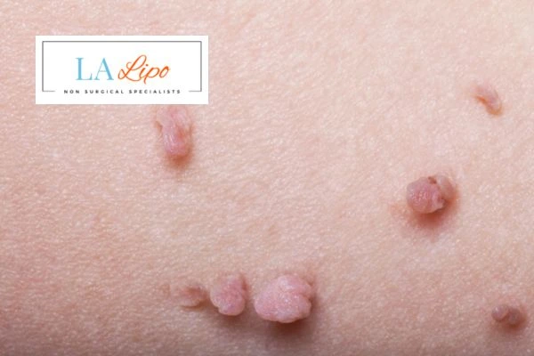 Does cryopen skin tag removal Richmond upon Thames hurt? Find out now call our team today!