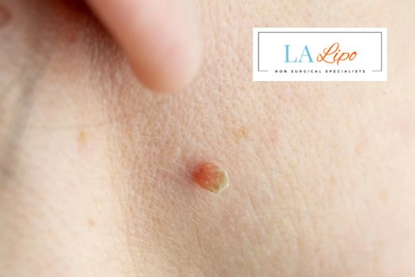 Book skin tag removal Richmond upon Thames today speak to our team now!