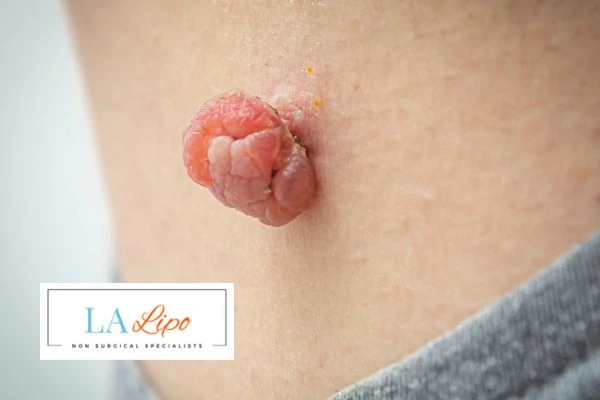 Interested in skin tag removal Richmond upon Thames? Concerned about the pain? Find out more today!