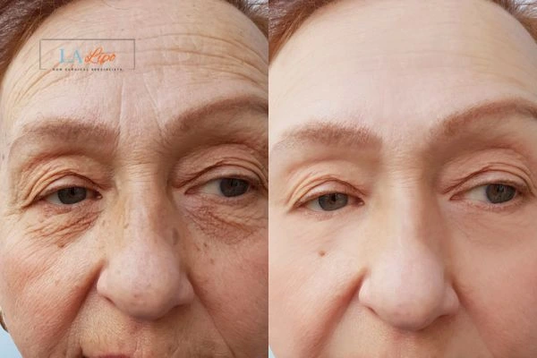 The powerful benefits of Morpheus8 Treatment Richmond upon Thames - Call Our team today!
