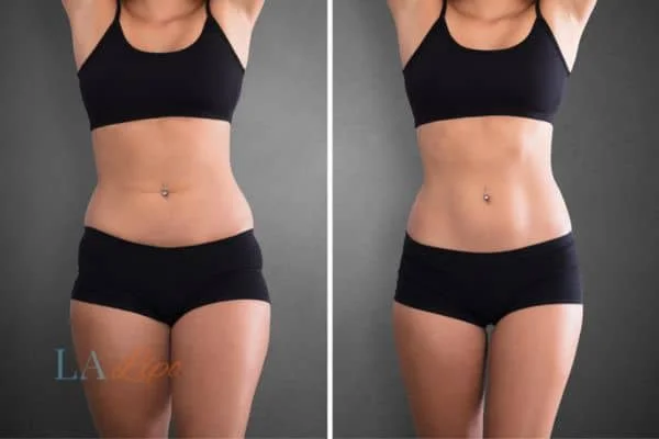 before and after results of non-surgical treatment to help a woman's body image and mental health Richmond upon Thames