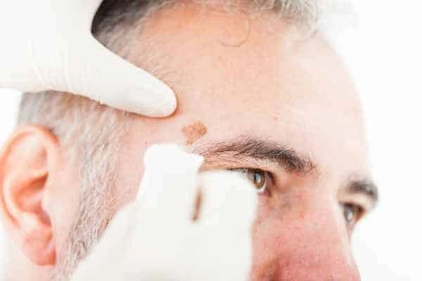 Age spots and elderly people Richmond upon Thames what is the link?