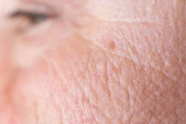 close up picture of a woman's face showing an age spot Richmond upon Thames