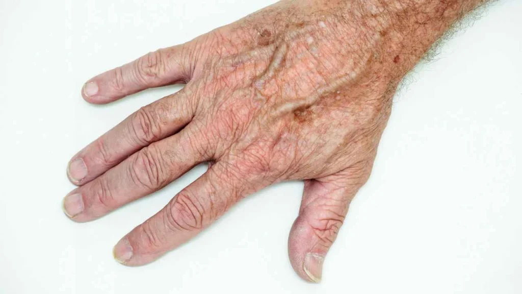 Male hand showing age spot Richmond upon Thames