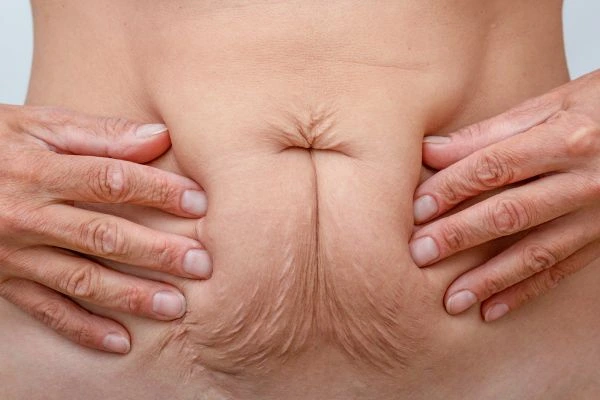 Should I Combine Diastasis Recti Treatment with Body Contouring for Better Results Richmond upon Thames?